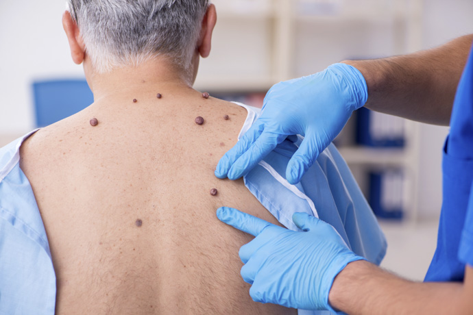 Médico aplica tratamiento para eliminar verrugas