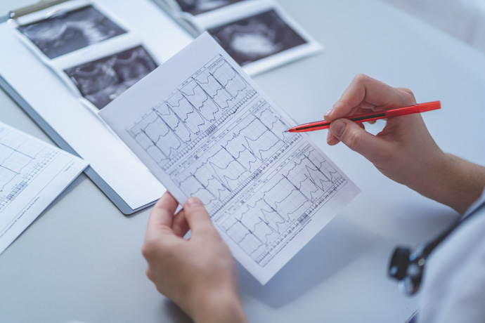 Electrocardiograma de paciente con angina de pecho