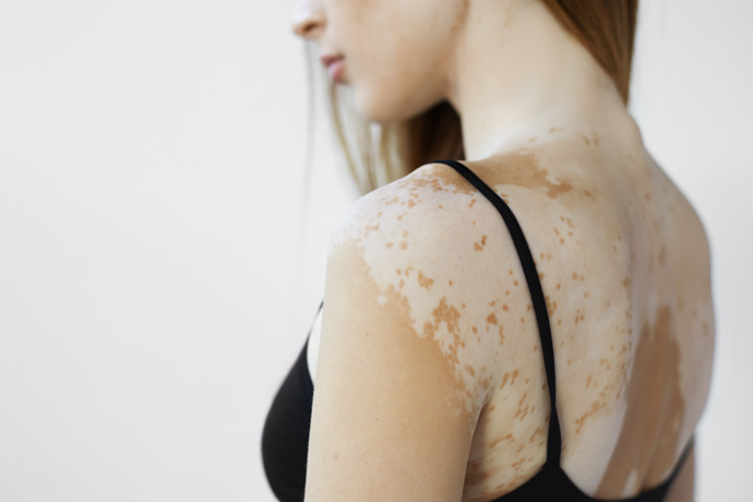 Mujer con manchas blancas en la piel por vitiligo