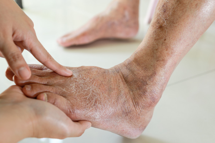 Médico recomienda tratamiento para pie diabético