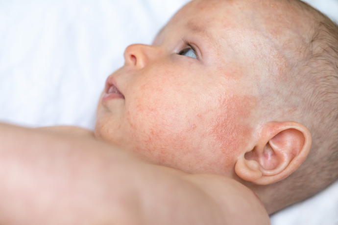 Niño con síntomas de dermatitis atópica