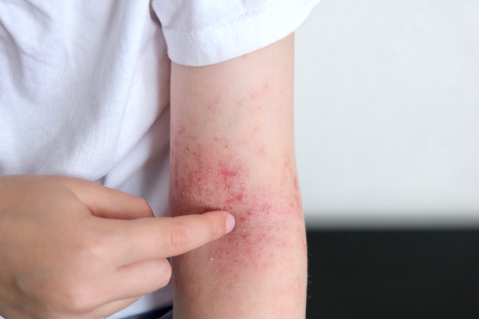 Ejemplo de un niño con sarpullido sin fiebre.