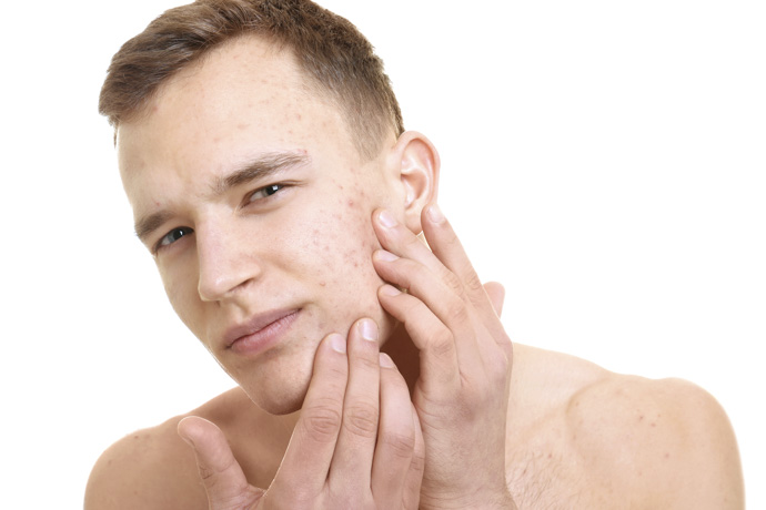Acné a causa de testosterona alta