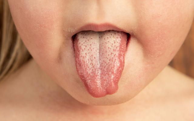 Niña con escarlatina enseñando lengua.