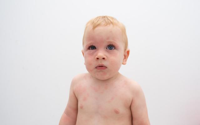 bebe con reaccion alergica