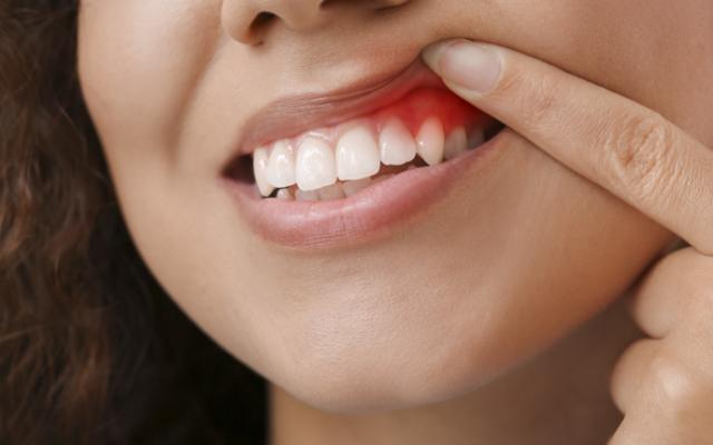 Mujer con encías inflamadas
