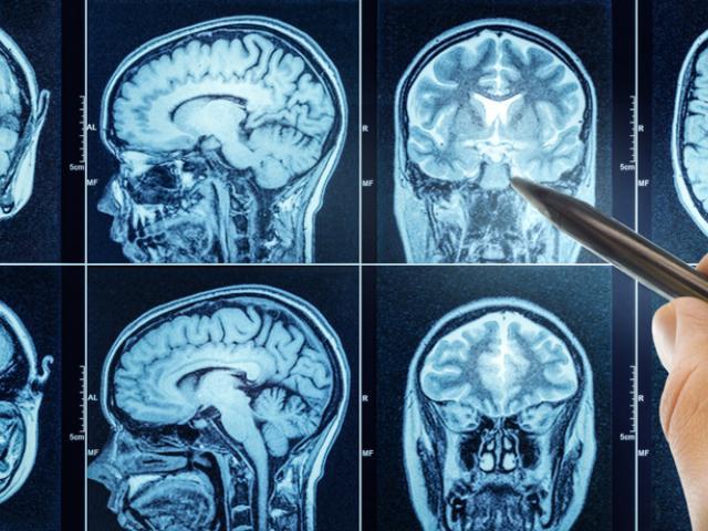 Escáner de cerebro que muestra el síndrome de Wernicke-Korsakoff.