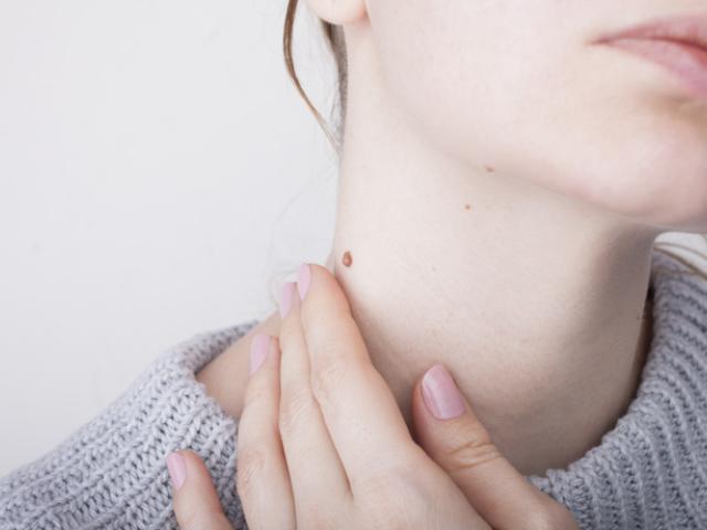 Mujer con verruga en el cuello