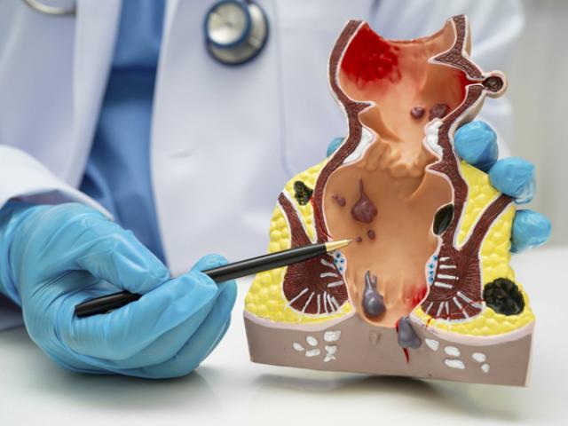 Doctor explica por qué salen las hemorroides