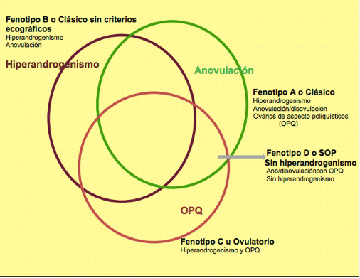 causas del síndrome de ovario poliquístico